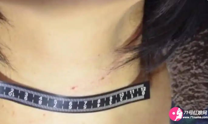 阿花身上的伤