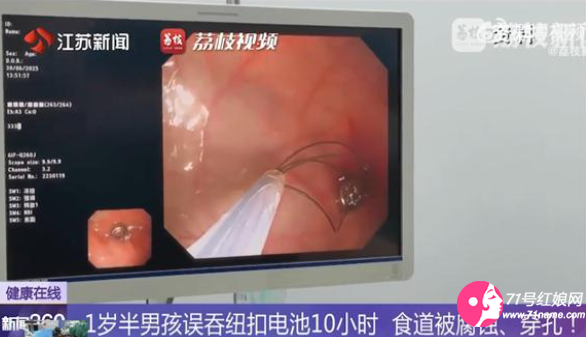 幼儿误吞电池