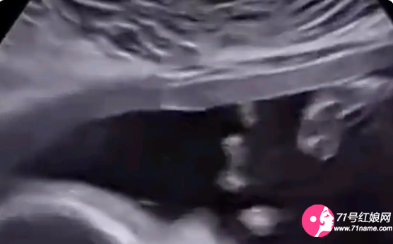 免疫系统致流产