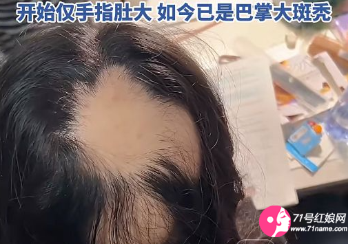 85后宝妈因辅导作业遭遇“鬼剃头”